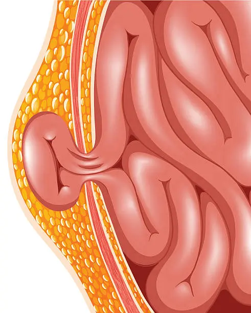 Hernias 1 HErnia