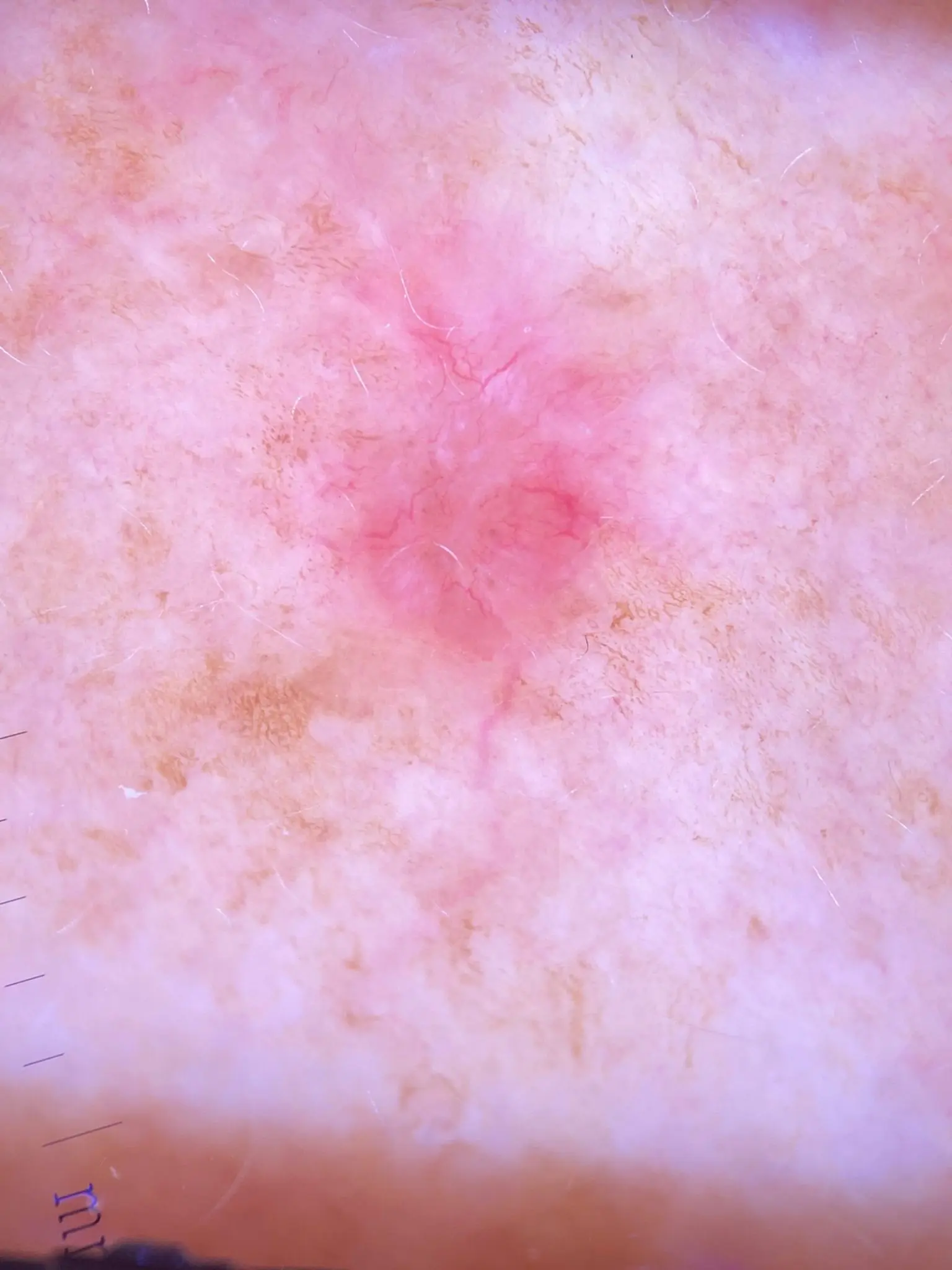 Basal Cell Carcinoma (BCC) 1 Image from Handyscope for non melanoma skin cancer section this is a BCC 1 scaled