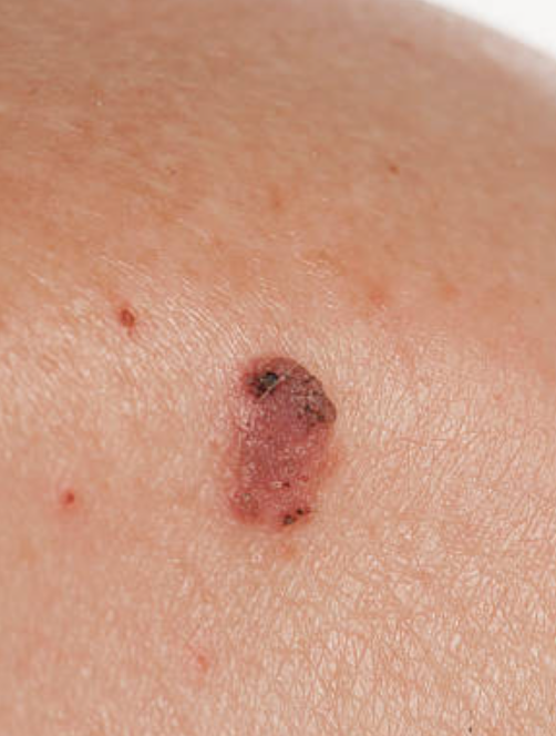 Squamous