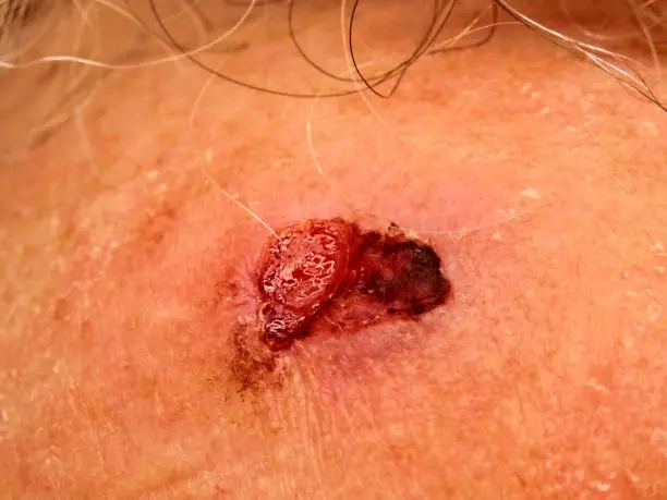 Squamous Cell Carcinoma (SCC) 2 istockphoto 1363688634 612x612 1