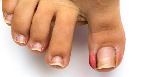 Ingrown Toenails 2 istockphoto 1438365566 612x612 1