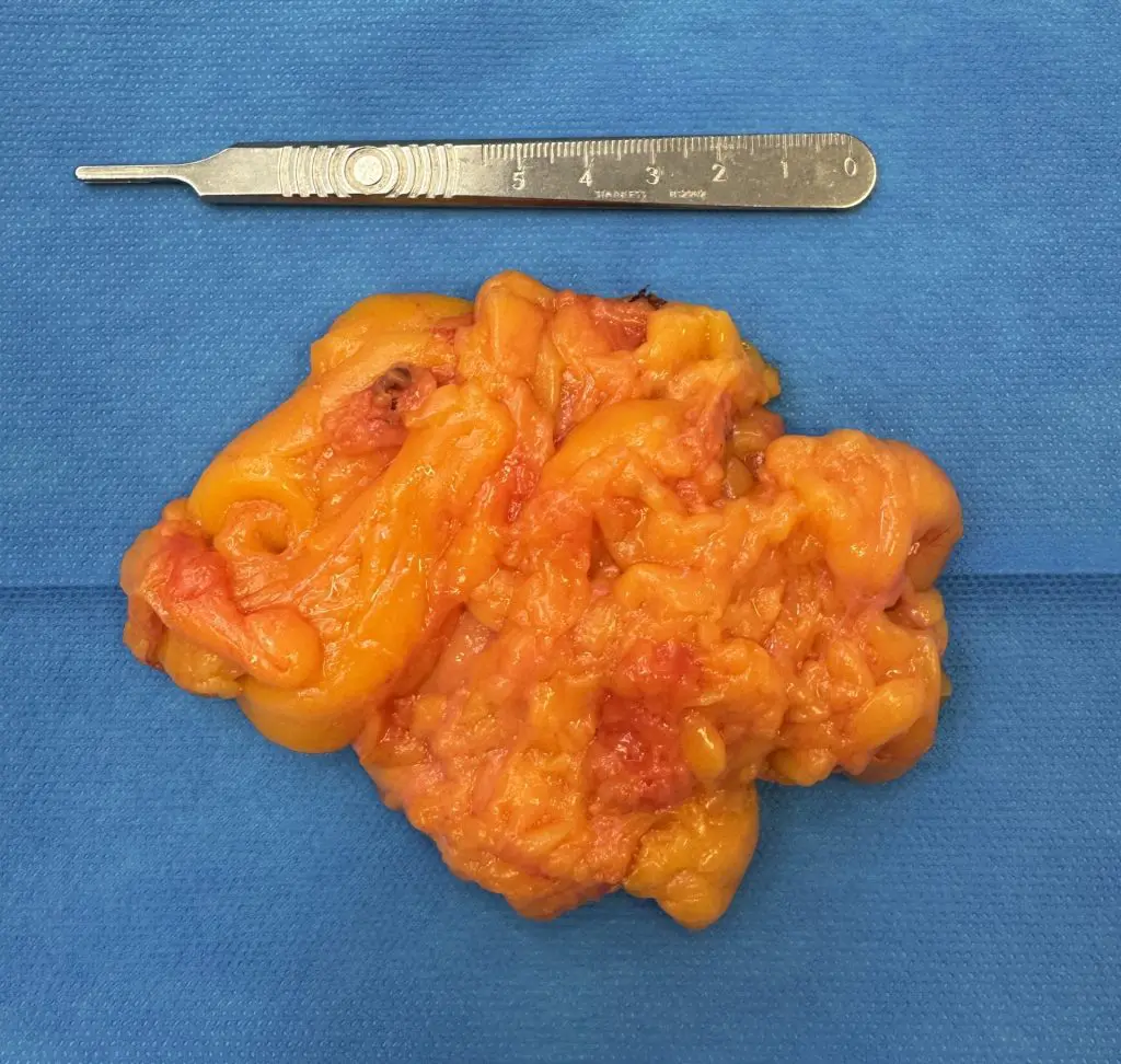 Cysts and Lipomas 2 Lipoma scaled e1749563086731