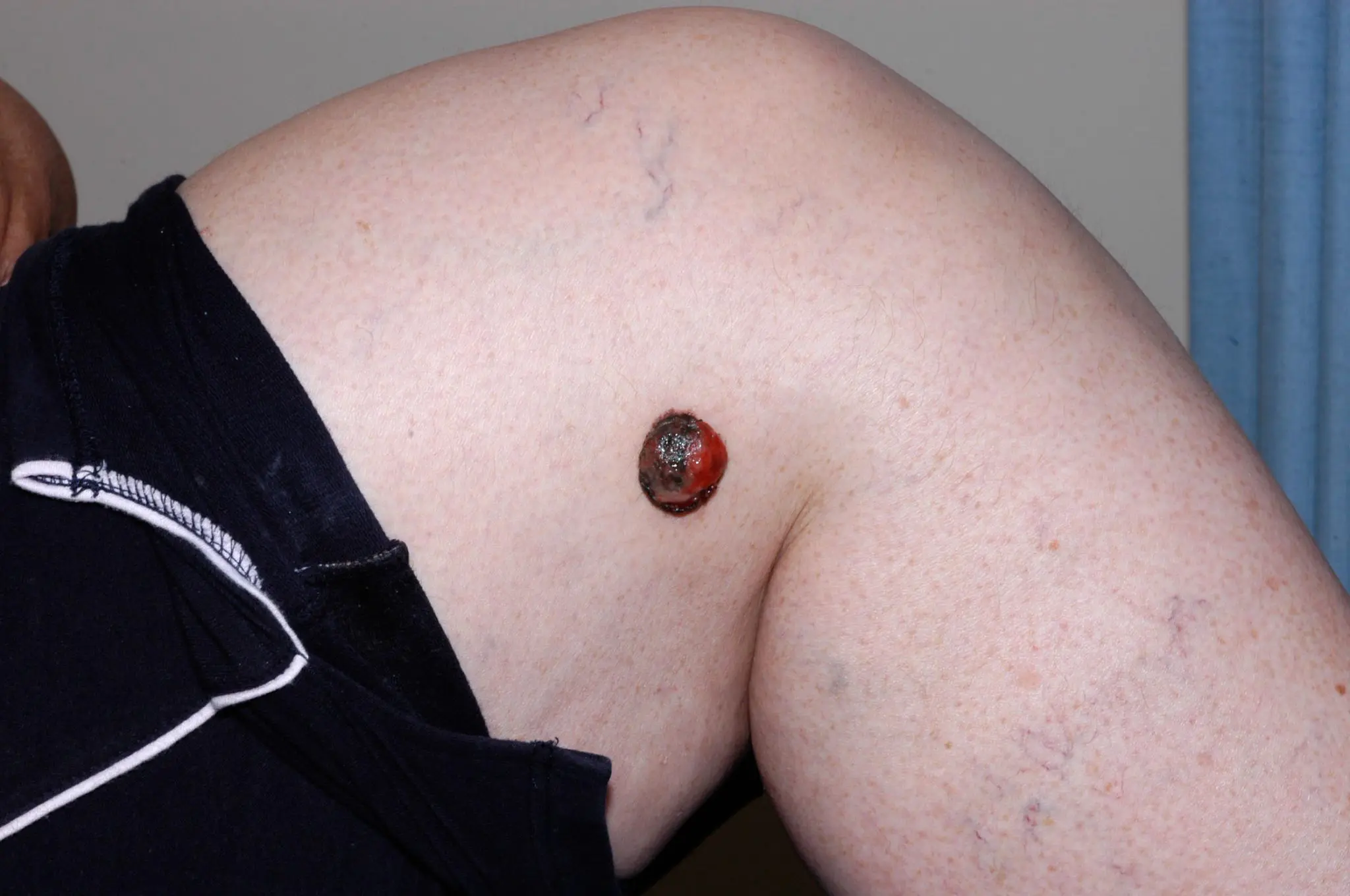 Melanoma 2 Melanoma new